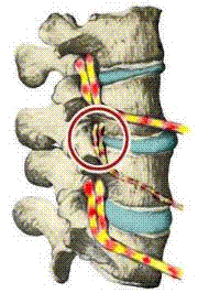 subluxation.214173142_std